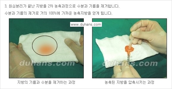 ​​​⁠[두한성형외과 경쟁력 미세지방이식] - [귀족수술 - 입체미세지방이식 ②] 관련 이미지 5
