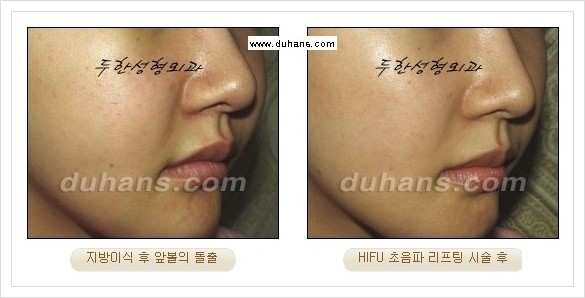 [두한성형외과 경쟁력 주름성형] - [HIFU 초음파 리프팅 주름교정술 안내 2.] 관련 이미지 18