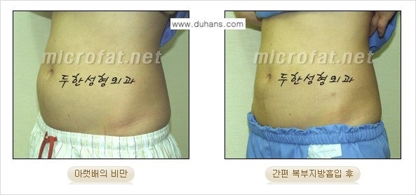 [두한성형외과 겨울엔 지방흡입] - [간편한 복부지방흡입 도전 2.] 관련 이미지 1