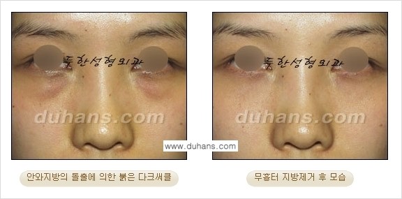 [두한성형외과 젊은 눈매 안검성형] - [눈밑 지방제거의 수술 전후 안내 ②] 관련 이미지 15