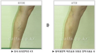 [종아리 두한성형외과] - [나에게 맞는 종아리시술] 관련 이미지 57
