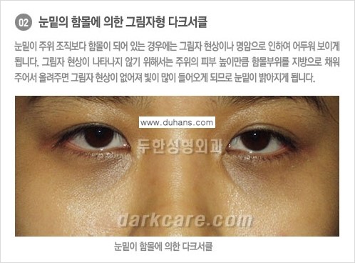 [두한성형외과 NO.1 경쟁력] - [원인과 색에 따른 다크써클의 종류] 관련 이미지 3