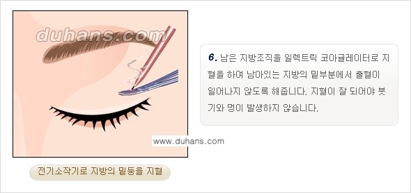 [두한성형외과 경쟁력 지방제거, 지방재배치] - [상큼하고 젊은 눈매 만들기 안내] 관련 이미지 8