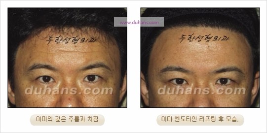 [두한성형외과 주름성형] - [주름교정술 - 강력한 리프팅 파워 엔도타인 리프팅 ] 관련 이미지 26