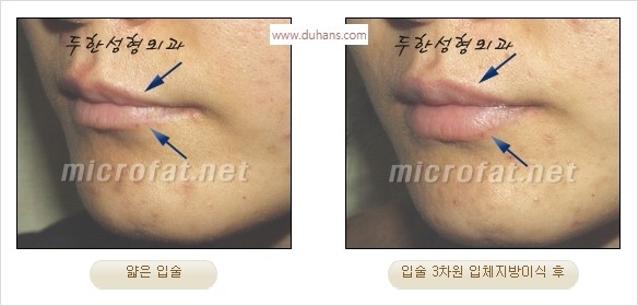 ​​[두한성형외과 경쟁력 미세지방이식] - [볼륨감 있는 입술성형] 관련 이미지 13