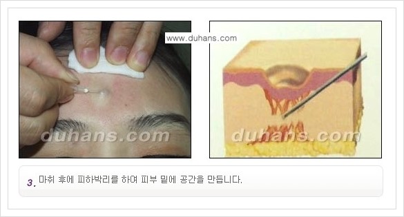 [두한성형외과 경쟁력 함몰 흉터 교정] - [동시에 3가지 시술로 효과적인 함몰 흉터 교정 안내] 관련 이미지 6