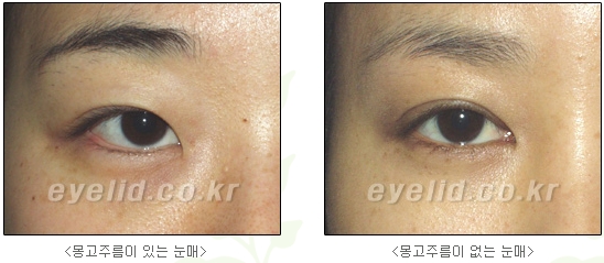 쌍커풀수술 두한성형외과 - 나에게 맞는 눈성형은? 관련 이미지 13