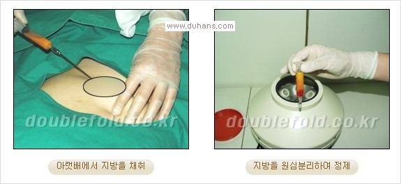 [두한성형외과 경쟁력 쌍꺼풀 재수술 리더] - [풀린 쌍꺼풀, 풀려버린 쌍꺼풀 재수술 방법 안내] 관련 이미지 2