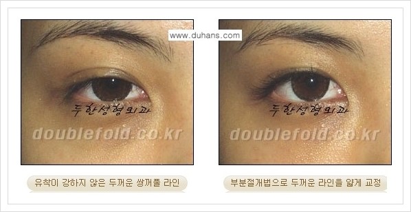 [두한성형외과 경쟁력 눈성형] - [부분절개법으로 두껍고 어색한 라인 교정 안내 2.] 관련 이미지 2