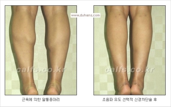 [두한성형외과 경쟁력 종아리성형 리더] - [종아리 성형 안내] 관련 이미지 5