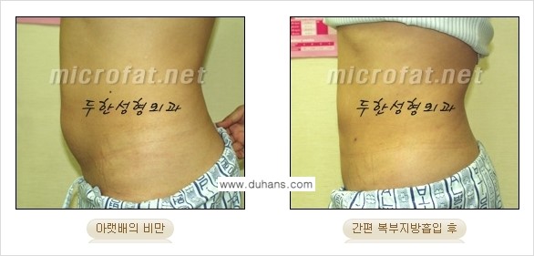 [두한성형외과 겨울엔 간편 지방흡입] - [복부, 뱃살, 아랫배, 옆구리 지방흡입 도전!] 관련 이미지 5