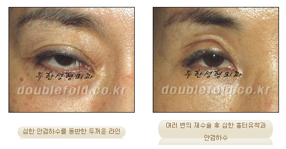 ​[두한성형외과 신두한 원장] - [극한 눈재수술 컬럼] 관련 이미지 1
