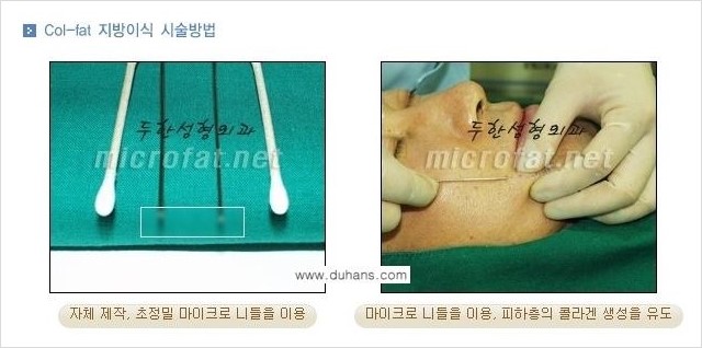 [두한성형외과 경쟁력 눈밑성형] - [눈밑 다크써클 원인과 눈밑 다크써클 치료 방법 안내] 관련 이미지 10