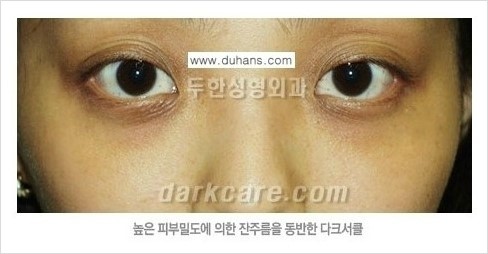[두한성형외과 경쟁력 눈밑성형] - [눈밑 다크써클 원인과 눈밑 다크써클 치료 방법 안내] 관련 이미지 8