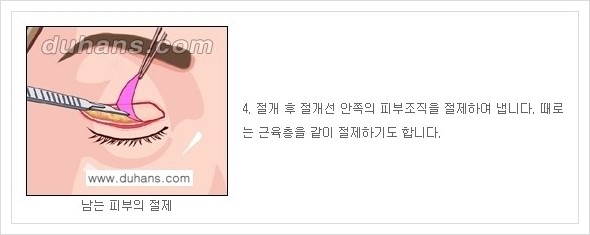 [두한성형외과 경쟁력 안검성형] - [상큼하고 환한 눈매의 완성 상안검 성형술 안내] 관련 이미지 4