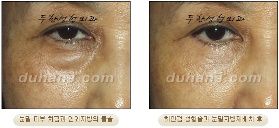 [Duhan Plastic Surgery Ophthalmic Plastic Surgery] - [Lower Blepharoplasty] image 10