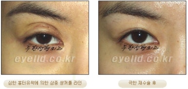 Duhan Plastic Surgery Ophthalmic Reoperation - What Is a Successful Double Eyelid Revision Surgery? image 12