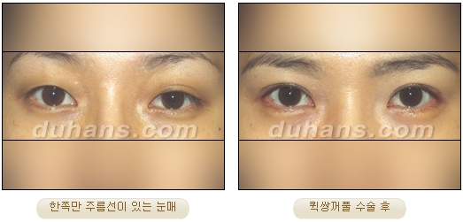 [Duhan Plastic Surgery Double Eyelid Surgery] - [Types of Double Eyelid Surgery] image 20