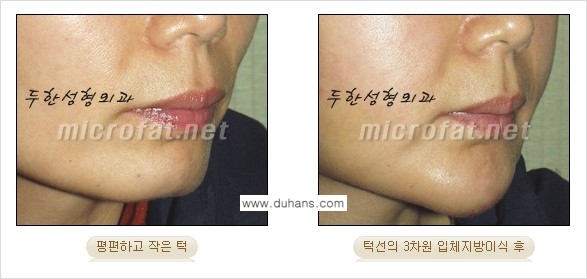 [두한성형외과 경쟁력 미세지방이식] - [얼굴 윤곽 무턱교정 안내 ②] 관련 이미지 7