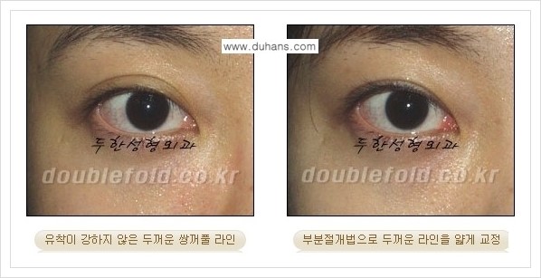 [두한성형외과 경쟁력 눈성형] - [부분절개법으로 두껍고 어색한 라인 교정 안내 2.] 관련 이미지 4