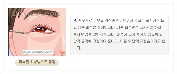 [두한성형외과 경쟁력 안검성형] - [젊은 눈매 하안검 성형술 안내] 관련 이미지 6
