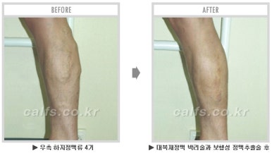 [종아리 두한성형외과] - [나에게 맞는 종아리시술] 관련 이미지 62