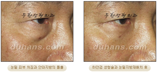 [Duhan Plastic Surgery Ophthalmic Plastic Surgery] - [Lower Blepharoplasty] image 21