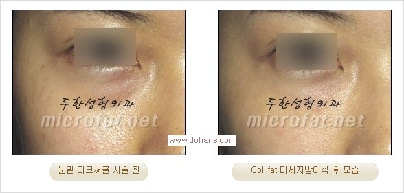 [두한성형외과 경쟁력 지방이식] - [두한 자가지방이식 클리닉 안내]​ 관련 이미지 52