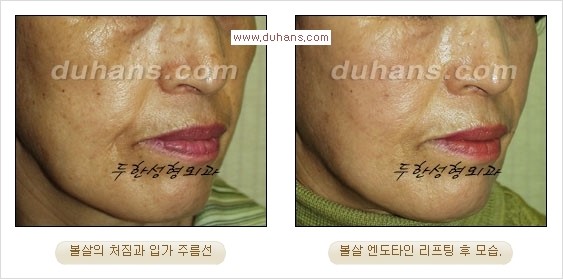 [두한성형외과 경쟁력 주름성형] - [눈썹거상, 앞볼처짐 개선의 엔도타인 리프팅] 관련 이미지 12