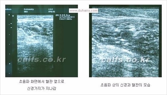 [두한성형외과 Dr. 컬럼 - 타 병원의 종아리 퇴축술 이후 문제가 발생한 경우] 관련 이미지 9
