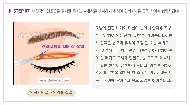 [두한성형외과 경쟁력 쌍꺼풀 재수술, 극한 재수술] - [쌍꺼풀 재수술의 과정 안내 1.] 관련 이미지 7