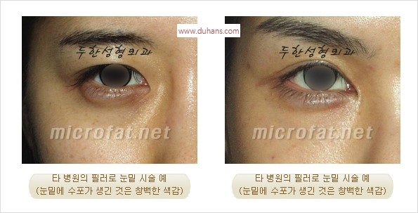 [두한성형외과 경쟁력 Quick 주름성형] - [주름교정을 위한 간편한 필러시술] 관련 이미지 12