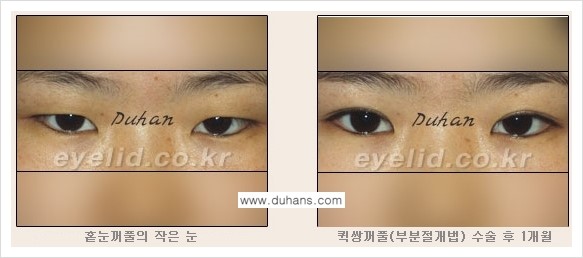 [두한성형외과 NO.1 눈성형] - [절개법과 매몰법 관련 흔한 질문과 답변] 관련 이미지 3