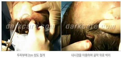 Duhan Plastic Surgery Combo Program - Dark Circles and Lifting image 21