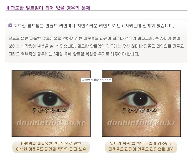 [두한성형외과 경쟁력 쌍꺼풀 재수술, 극한 재수술] - [쌍꺼풀 재수술, 극한 재수술 시 문제점 안내] 관련 이미지 5