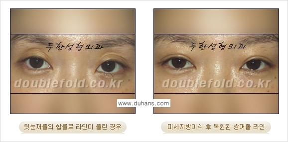 [두한성형외과 NO.1 눈성형] - [함몰된(꺼진) 눈꺼풀에서 쌍꺼풀 라인 교정 3.] 관련 이미지 12