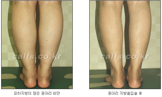 두한성형외과 지방흡입 - 부위별 안전 지방흡입 관련 이미지 31