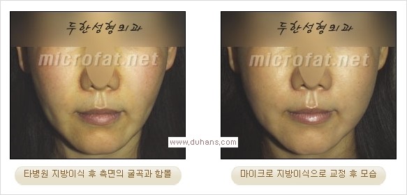 [두한성형외과 경쟁력 미세지방이식] - [볼살, 이마, 측두부 - 안면윤곽 미세지방이식] 관련 이미지 13
