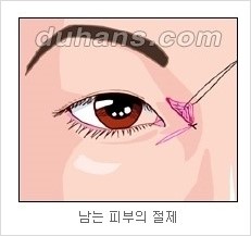 쌍커풀수술 두한성형외과 - 나에게 맞는 눈성형은? 관련 이미지 57