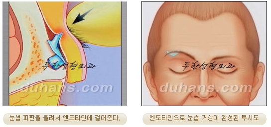 두한성형외과 안티에이징 리프팅 - 엔도타인 리프팅 관련 이미지 36