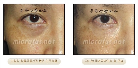 ​[두한성형외과 경쟁력 눈밑성형 리더] - [눈밑 다크써클의 증상, 원인, 종류, 치료방법 안내] 관련 이미지 23