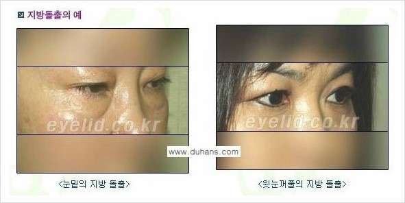 ⁠⁠[두한성형외과 경쟁력 안검성형] - [젊은 눈매를 위한 윗눈꺼풀 지방제거, 눈밑 지방제거] 관련 이미지 2