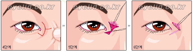[Duhan Plastic Surgery Eyelid Surgery] - [Epicanthoplasty, Medial Canthoplasty] image 8