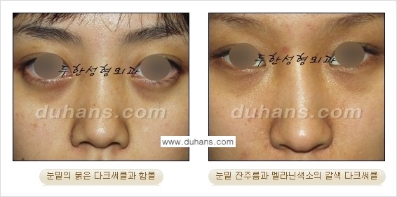 [두한성형외과 경쟁력 미세지방이식] - [다크써클 & 눈밑주름 미세지방이식 1.] 관련 이미지 3