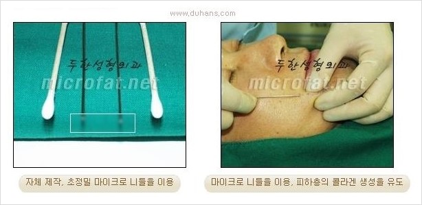 [두한성형외과 경쟁력 눈밑성형] - [눈밑 다크써클과 눈밑 함몰주름의 최적화 교정방법 안내] 관련 이미지 3