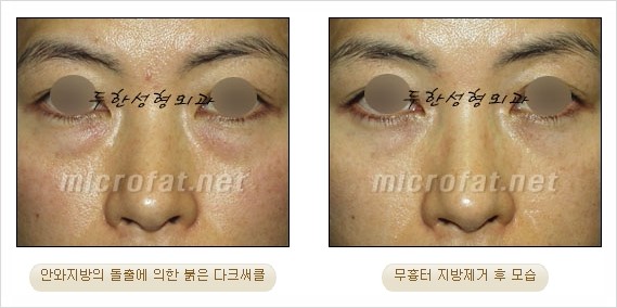 [두한성형외과 쌍커풀수술] - [눈성형 방법에 대한 자주하는 질문과 답변] 관련 이미지 164