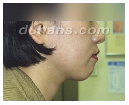 [두한성형외과 보톡스시술] - [사각턱 보톡스 안내] 관련 이미지 14