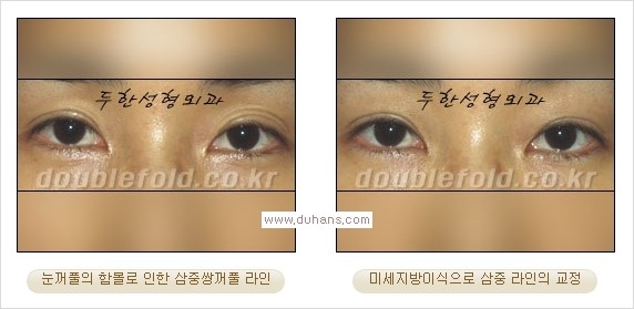 ​⁠⁠[두한성형외과 경쟁력 쌍꺼풀 재수술, 극한 눈재수술] - [지방이식으로 눈매와 쌍꺼풀 라인을 교정] 관련 이미지 18