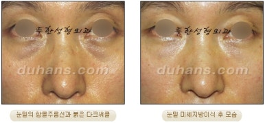 두한성형외과 눈밑성형 - 눈밑지방제거, 눈밑주름, 눈밑지방재배치 관련 이미지 67