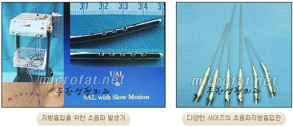[Duhan Plastic Surgery Liposuction] - [Facial Liposuction] image 5